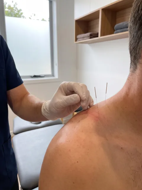 Dry needling: dunne naalden in de bovenrugspieren